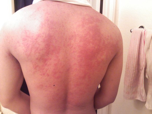 hives_on_back