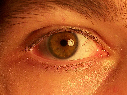 Lentille oeil